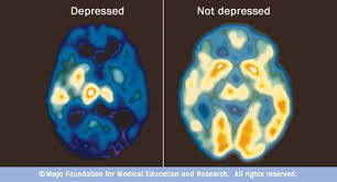 Depression is more than simply feeling unhappy or fed up for a few some people think depression is trivial and not a genuine health condition. Depression Overview Emotional Symptoms Physical Signs And More