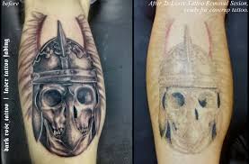 And for per treatment, you will need. Dark Rose Tattoo Laser Tattoo Removal Justyna Kurzelowska