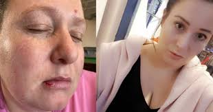 Savage seagull attack leaves tourist with burst lip after birds swipe mini  egg from her mouth