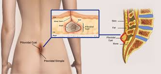 Image result for Pilonidal Cyst