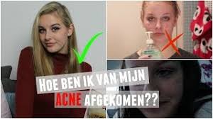 Yasmin bij acne/puistjes | medicijn ervaringen en bijwerkingen de puistjes zitten in het gezicht, op de rug, op de borst, of op de schouders. Hoe Ik Van Mijn Acne Ben Afgekomen Youtube