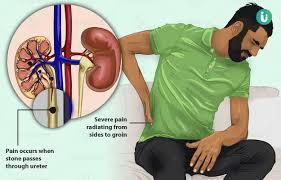 Kidney Stones Symptoms Causes Treatment Medicine Prevention Diagnosis