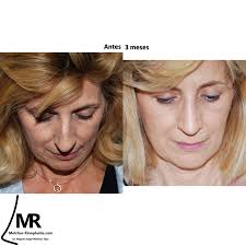 Miguel Angel Melchor Diaz (@dr.melchor.rinoplastia) • Instagram photos and  videos