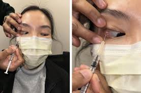 Image result for Botulinum Toxin Injection