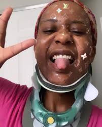 ShanaB gets her halo brace removed...