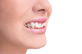As far as normal overbite is concerned, there is no need to panic. Your Overbite Guide Causes And Treatment Methods Absolute Dental