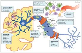 La esclerosis múltiple es una enfermedad autoinmune, que afecta al sistema nervioso central, cerebro, médula espinal y tronco del encéfalo. Https Siidon Guttmann Com Files 20 Tfm Nicolas Valverde Pdf