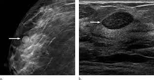 Diagnostic mammograms are usually interpreted in the same day, unless old films are needed. Six Month Follow Up Appropriate For Bi Rads 3 Findings On Mammography