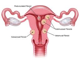 What Should I Know About Fibroids And Polyps Myosure
