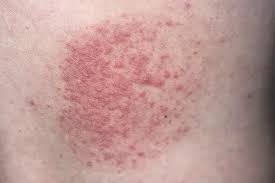 Image result for sweat rash on back