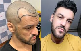 O transplante capilar é um procedimento cirúrgico que tem como objetivo preencher a área sem cabelo com cabelo da própria pessoa, seja da nuca, peito ou costas. Sensul Acelor De Ceasornic Salvie NemaivÄƒzut Implante Capilar Burnfoothouse Com