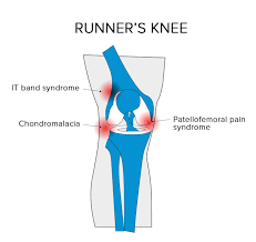 Runner's Knee: Healing & Prevention Tips - Road Runner Sports