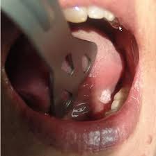 Image result for papillomavirus tongue)