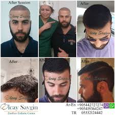 If you are thinking about a procedure for a hair transplant in i suffer with polycystic ovary syndrome ( pcos ) due to this i have so much facial and body hairs. Hair Transplant In Turkey Hair Transplant Hair Implants Hair Loss Men