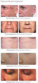 What is a cherry angioma? Port Wine Stains Cherry Angioma Beauty Treatments Salon Laser Of Beauty
