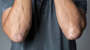 'psoriases' is a 9 letter word starting with p and ending with s. Schuppenflechte Psoriasis Verlauf Folgen Behandlung Gesund Bund De