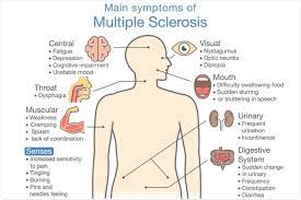 Recommended diagnostic criteria for multiple sclerosis: Early Signs Of Multiple Sclerosis