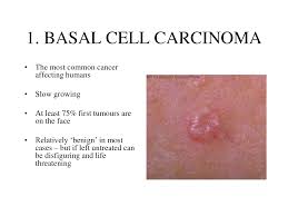 Basal Cell Carcinoma Google Search Basal Cell Basal Cell Carcinoma Squamous Cell