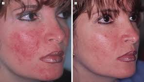 Afbeeldingsresultaat voor Acne Rosacea Skin Care