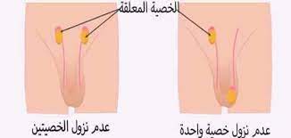 علاج الخصية المعلقة عند الكبار بالأعشاب بدون جراحه مقال