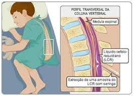 meningite