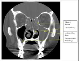 Image result for Rhinosinusitis