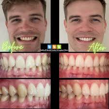 Invisalign invisalign braces are great for closing the gaps in your teeth as well as straightening crooked teeth. Invisalign Invisible Braces Solihull Dental Centre