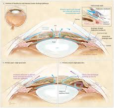 Image result for Acute Vision Loss