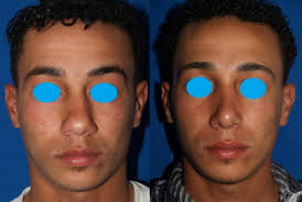 Etiology, diagnosis, and treatment of the nasal valve collapse. Crooked Nose An Update Of Management Strategies Sciencedirect