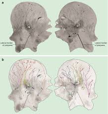Lymphadenopathy is a clinical feature of several different types of pathology including infections, lymphomas, leukaemias and local metastatic malignancy. Lymphatic Anatomy And Clinical Implications Springerlink