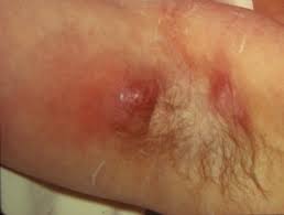 Warm compress is easy to apply and it is very effective. Cutaneous Abscess Dermnet Nz