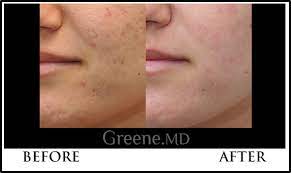 1540 fractional laser before and after. Palomar Laser Skin Rejuvenation Weston Treats Skin Texture Scars And Stretch Marks Fort Lauderdale Miami Laser Center