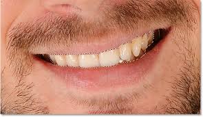 Just use these great teeth whitening apps. How To Whiten Teeth In Photoshop Step By Step