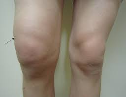 Image result for Knee Bulge Sign