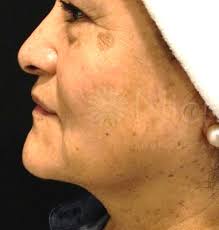 Facial Balancing Treatments