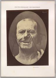 Guillaume-Benjamin-Amand Duchenne de Boulogne