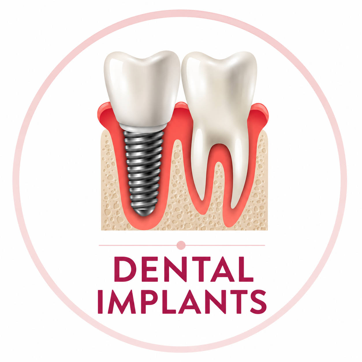 Single Tooth Implant Replacement product image