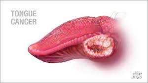 Image result for cancer tongue symptoms)