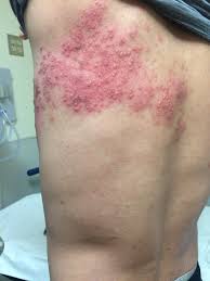 Sorry for not being able to respond earlier. Herpes Zoster Jetem