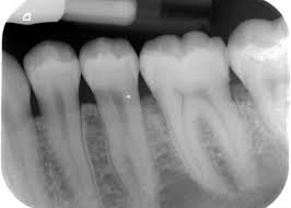 In most cases the headaches were in the temporal areas and related to muscles. Https Www Xn Zahnrzte Mnchen 3kb82b De En Tooth Preservation Root Canal Treatments Html
