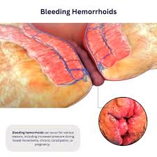 Image result for hemorrhoids