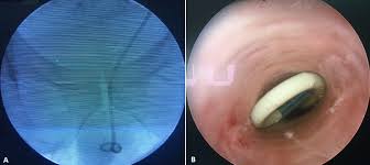Migration Of A Double J Stent Presenting As A Painless Total Urinary Incontinence