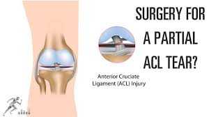 Diagnosis can be suspected clinically with presence of a traumatic knee effusion with increased laxity. Do You Need Surgery For A Partial Acl Tear Youtube