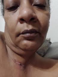 Does anyone have exocrine pancreatic insufficiency and or tachycardia with  this condition? I have these two conditions now and thyroid hashimotos