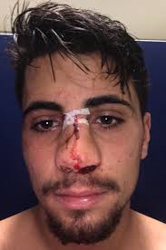 €* 19 nis 1994, águeda, portekiz. Rangers Star Fabio Cardoso Posts Shocking Picture Of Battered Face As He Confirms His Nose Was Broken In Clash With Motherwell S Ryan Bowman