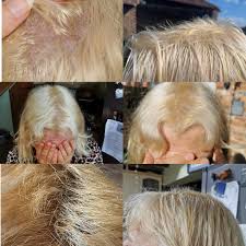Burning scalp hair loss happens when lice bite the scalp, and you scratch it. My Mum S Hairdresser Did This To Her Her Scalp Is Burnt Her Hair Is Falling Out Down The Center And She Has A Yellow Stripe What Can She Do To Help Her