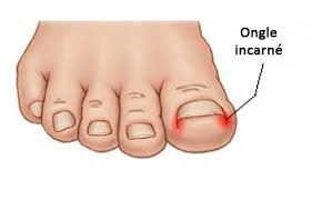 Pathologie L Ongle Incarne Podologue Saint Pierre