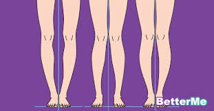 How To Straighten Bow Legs In Adults Without Surgery Exercises For Bow Legs Correction Bow Legged Correction Bow Legged Slim Legs Workout