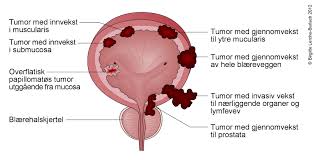 Etter at pasienten har fått bedøvelseskrem i urinrøret fører legen. Cystoskopi Nhi No