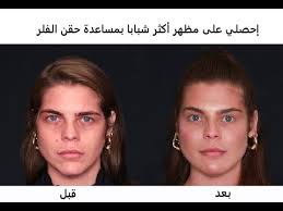 حقن الفيلر قبل وبعد الأخصائية الدكتورة ليلى ارفاس